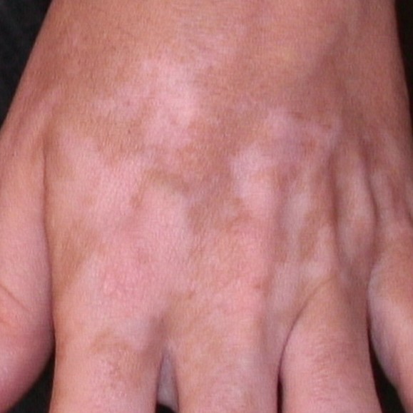 vitiligo