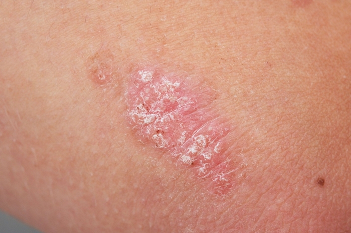 PUVA und NB-UVB bleiben eine wirksame Behandlung gegen Psoriasis; Mai 2021 Forschung