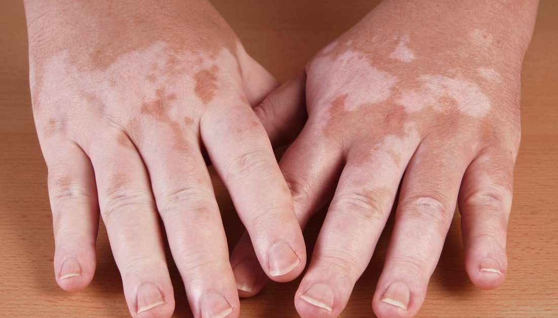 Die Ergebnisse dieser systematischen Überprüfung und Metaanalyse deuten darauf hin, dass die UV-Phototherapie eine sichere Behandlung für Vitiligo ohne signifikantes Hautkrebsrisiko darstellt.